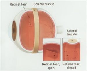 torn retina repair recovery torn retina repair recovery